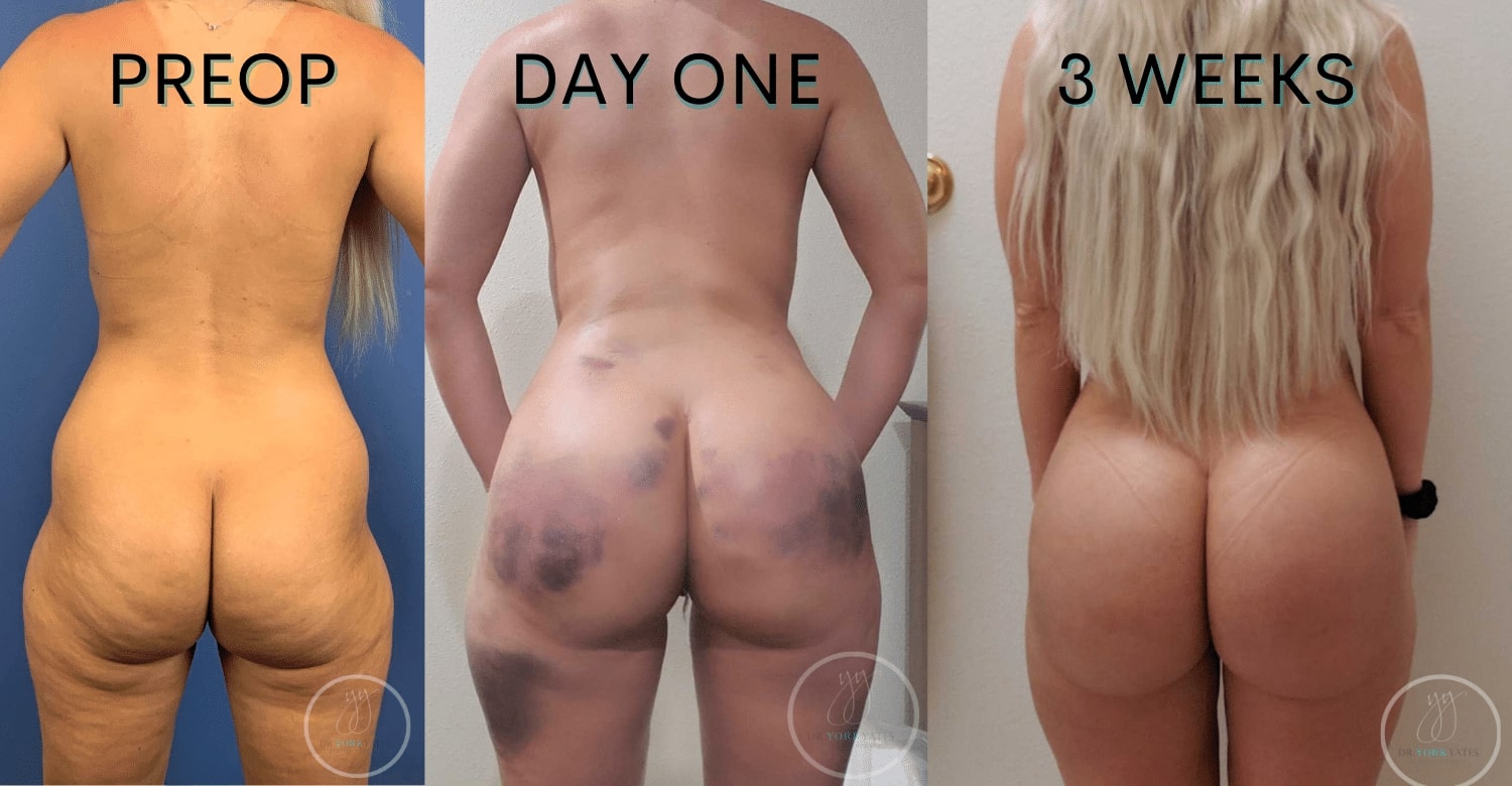 Different Types Of Brazilian Butt Lift (BBL) & How To Ask For The