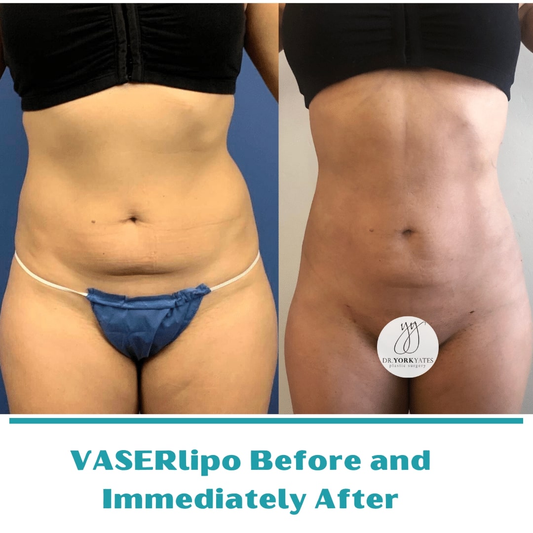 Stomach liposuction: cost, procedure, results before and after