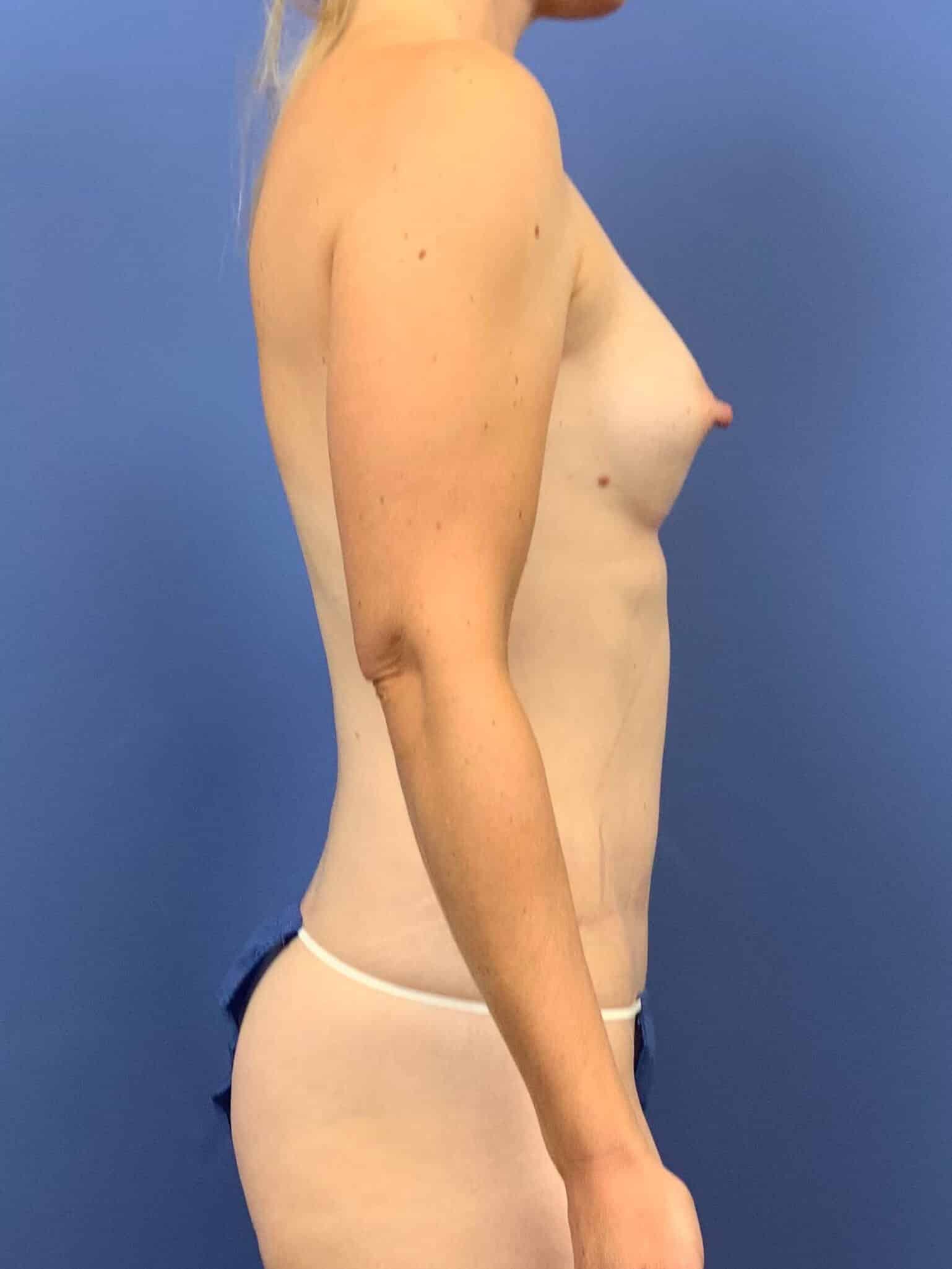 After Image: Patient 44076 - right-side