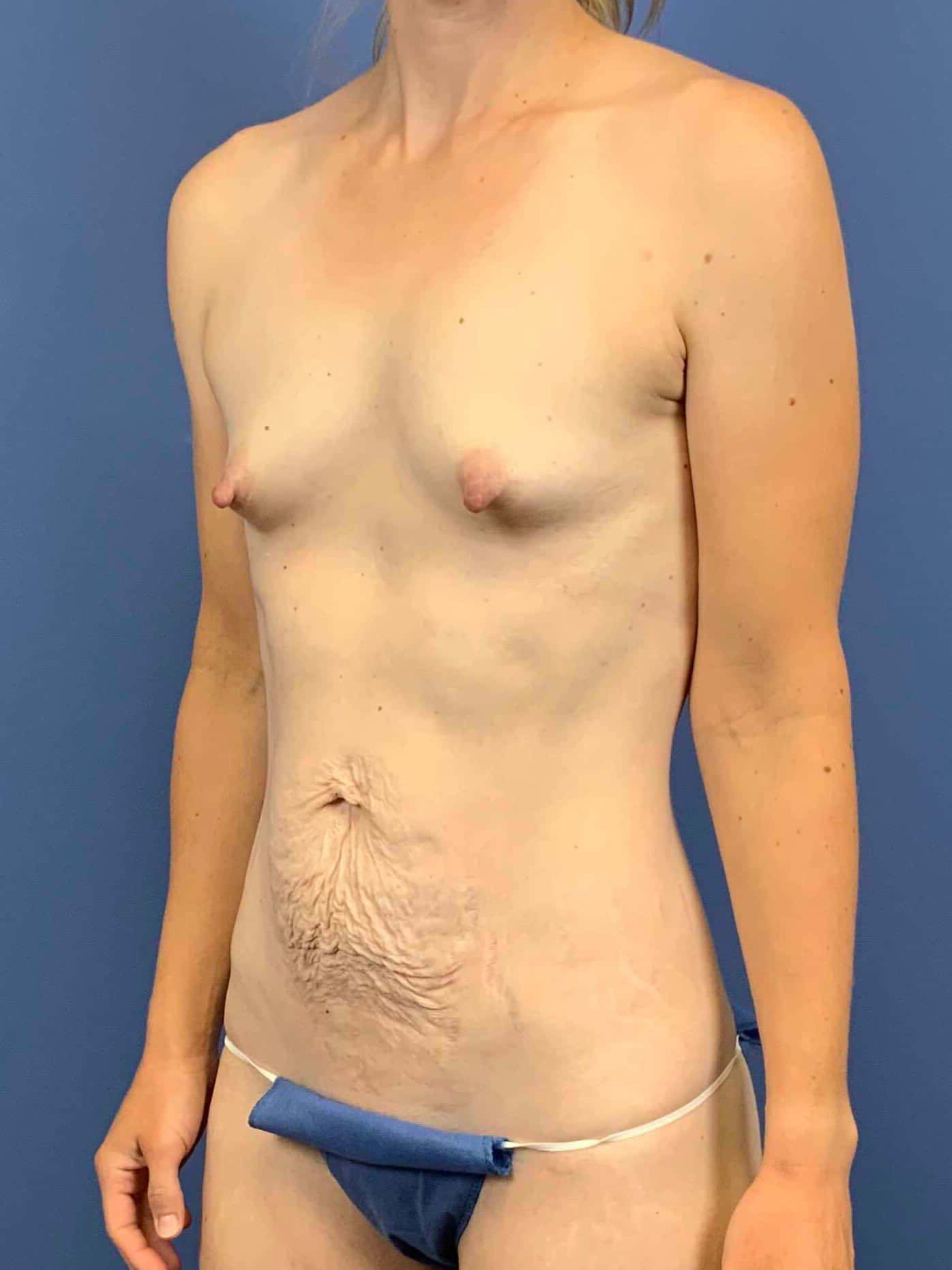 Before Image: Patient 44076 - left-front-oblique