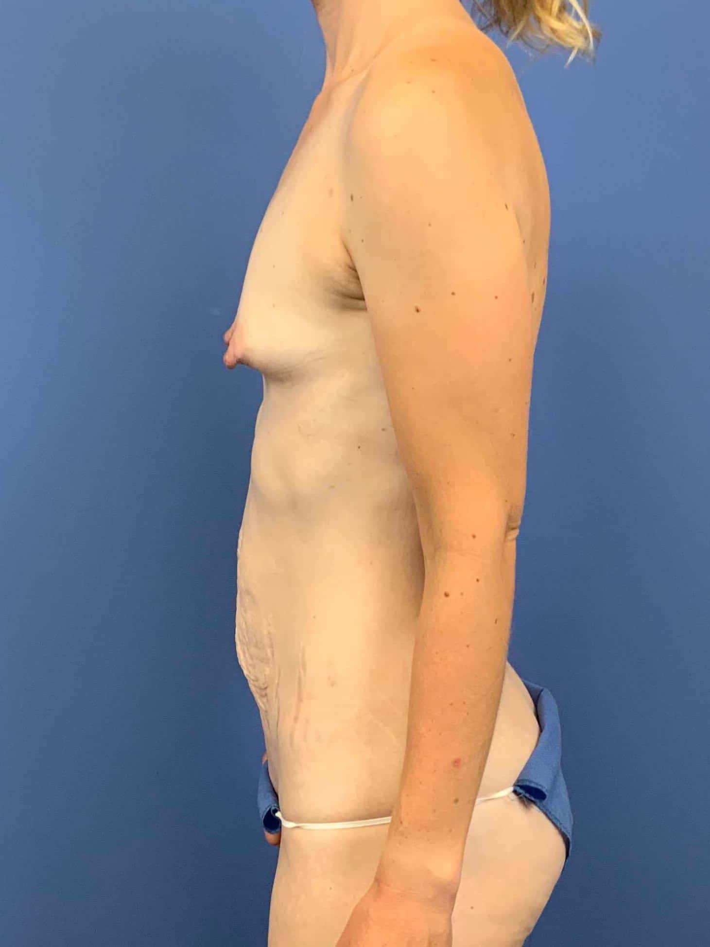 Before Image: Patient 44076 - left-side