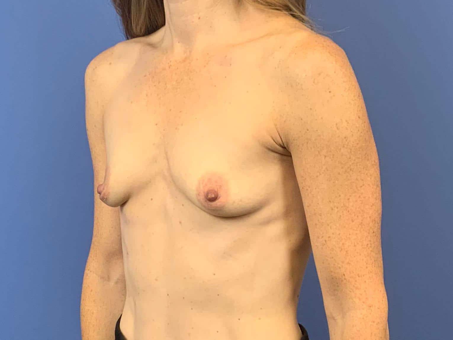 Before Image: Patient 44043 - left-front-oblique