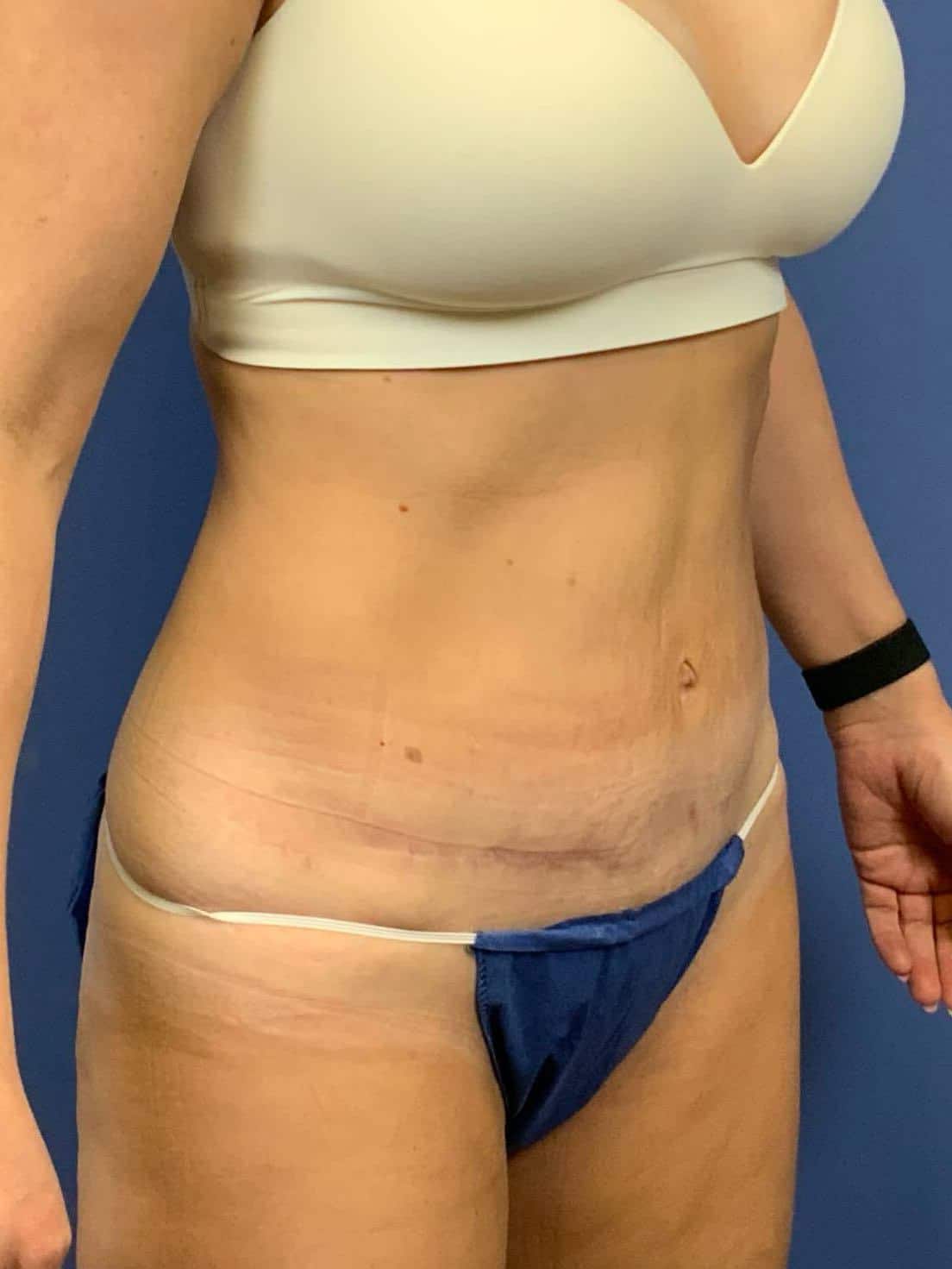 After Image:  - right-front-oblique