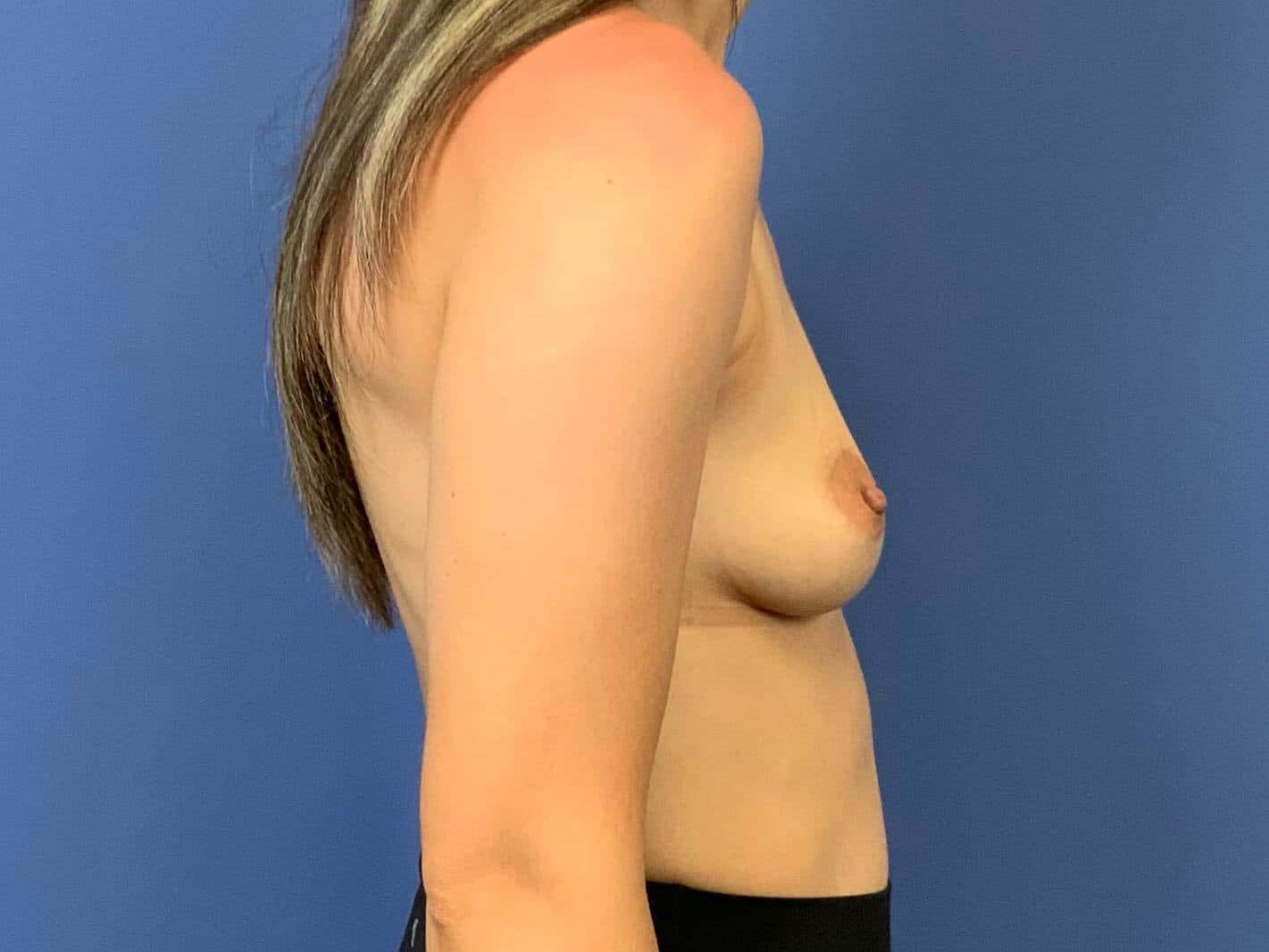 Before Image:  - right-side