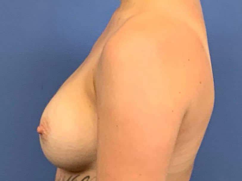 After Image:  - left-side