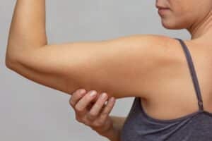 Woman with sagging upper arms before arm lift in Layton, UT